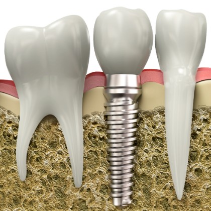 Dental Implants, Burlington Dentist